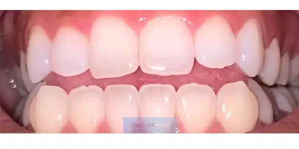 Teeth after whitening treatment