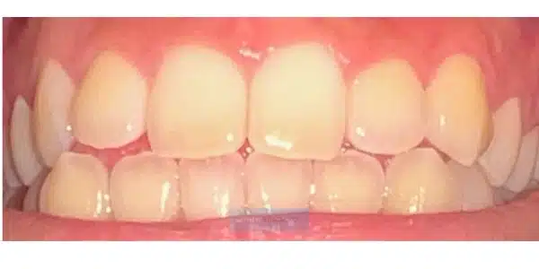 Teeth before whitening treatment